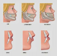 龅牙矫正究竟哪种方法好呢？