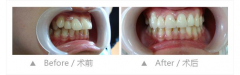 成人龅牙矫正需要多长时间