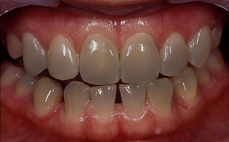 美白 牙黑每个人都希望有一口健康洁白的牙齿,然而生活中一些人出现