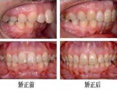 广州圣贝专家详解矫正龅牙的快速方法