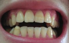 牙齿变黄，炫彩美白可以让它“白”回来