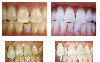 牙齿黄怎么办
