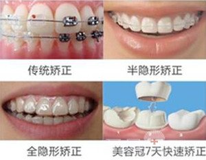 成都牙齿矫正哪家医院好2