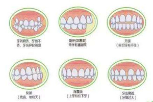 牙齿畸形_副本.jpg