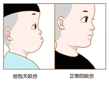 地包天..jpg