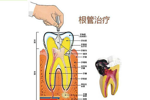根管治疗