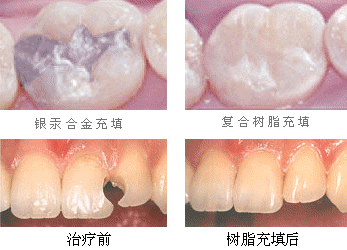 隐形牙齿矫正需要注意些什么