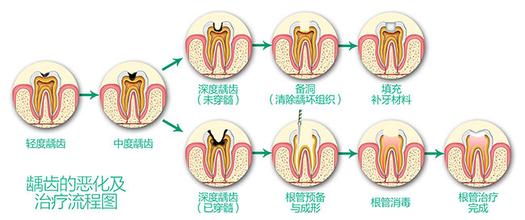 隐形牙齿矫正需要注意些什么